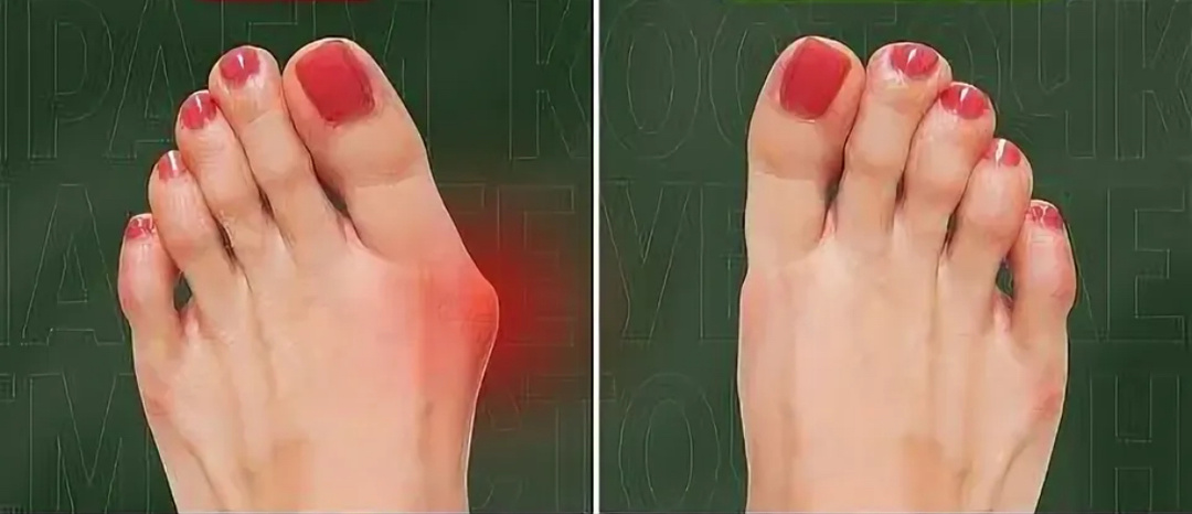 5 упражнений, когда надоели косточки на больших пальцах стоп