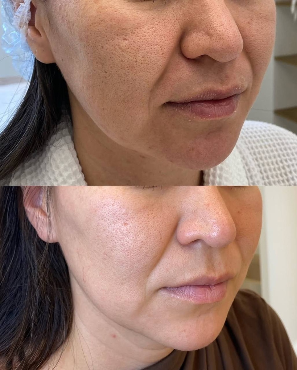 📸 На фото — результат уже после одной процедуры.