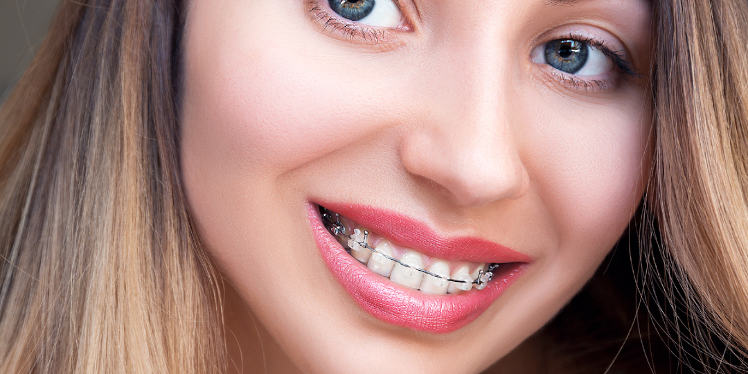 Что такое сапфировые брекеты и какие есть альтернативы