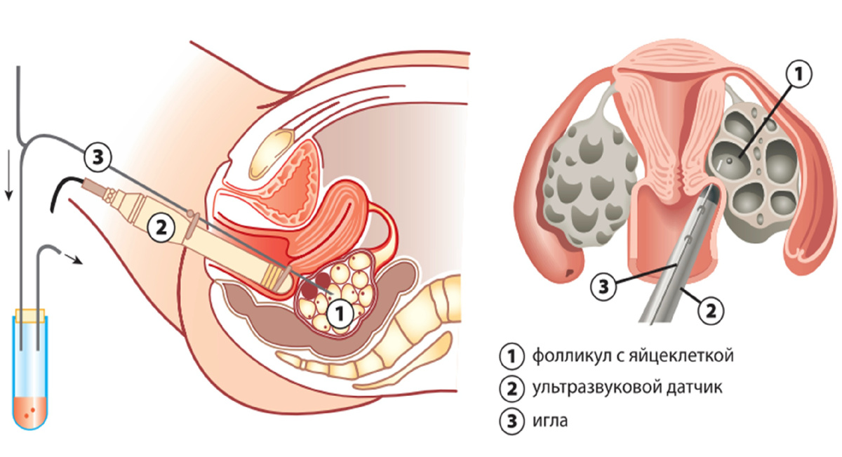 Процедура пункции фолликулов
Ультразвуковой датчик, вводимый во влагалище, направляется к яичнику.
Стенка влагалища и яичник с фолликулами прокалываются полой иглой, закрепленной на датчике.