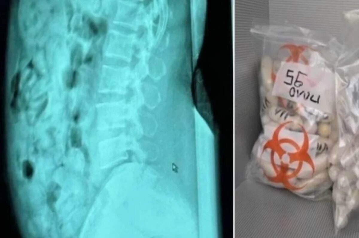    Румынка пыталась ввезти в Италию в желудке 120 контейнеров с героином