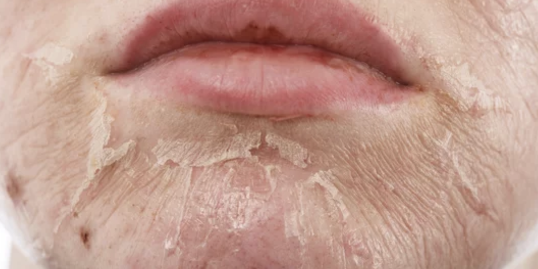 Кислотный пилинг для лица: когда на пользу, а когда во вред!