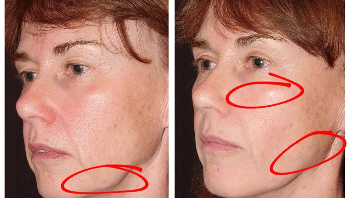 Пример фиброза тканей лица 