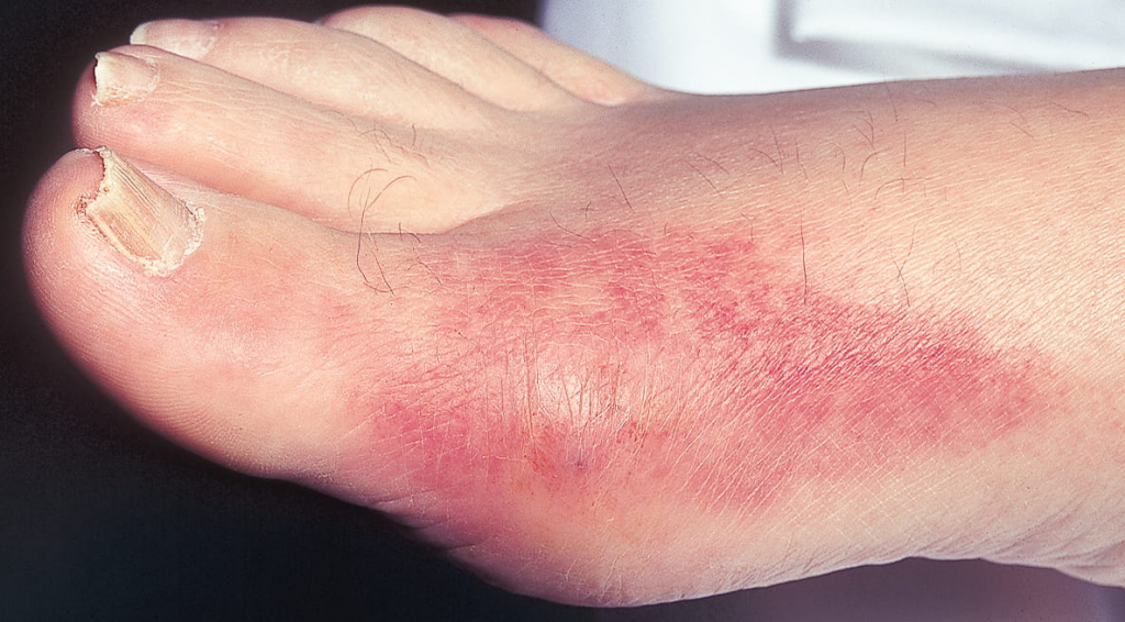 Рис. 1. Классический дебют подагры: поражение первого плюсне-фалангового сустава, сопровождающееся острой болью, покраснением и отеком