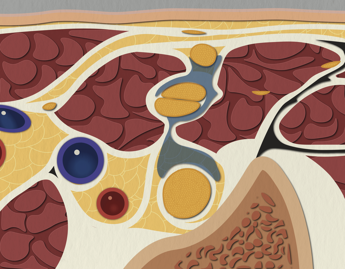 АНАТОМИЯ МЕЖЛЕСТНИЧНОЙ БЛОКАДЫ (ИЛЛЮСТРАЦИЯ)