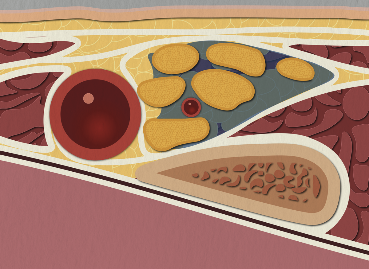 АНАТОМИЯ НАДКЛЮЧИЧНОЙ БЛОКАДЫ (ИЛЛЮСТРАЦИЯ)
