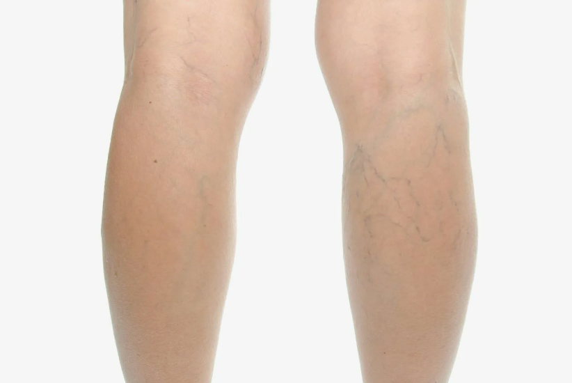 Варикозного расширения вен