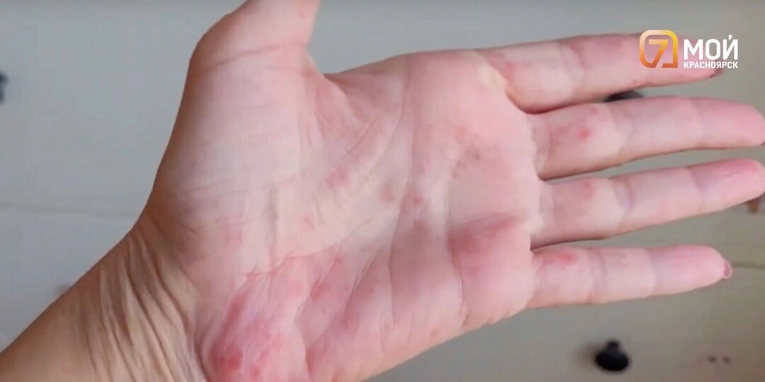 Красноярцы болеют Коксаки, группы в детсадах уходят на карантин. Что говорят врачи