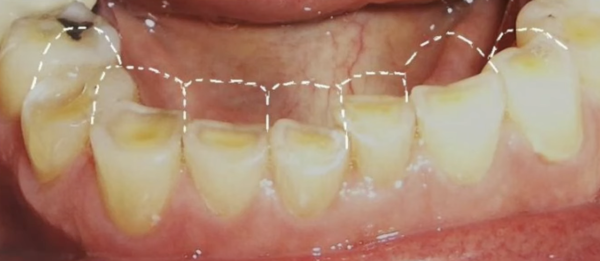 Истирание зубов