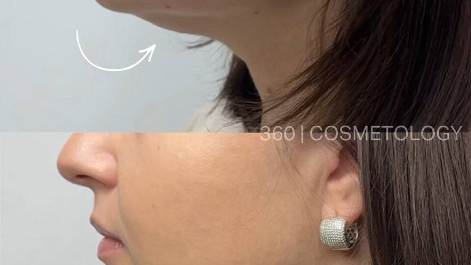 Как получить стройное лицо за одну процедуру в 360 | COSMETOLOGY