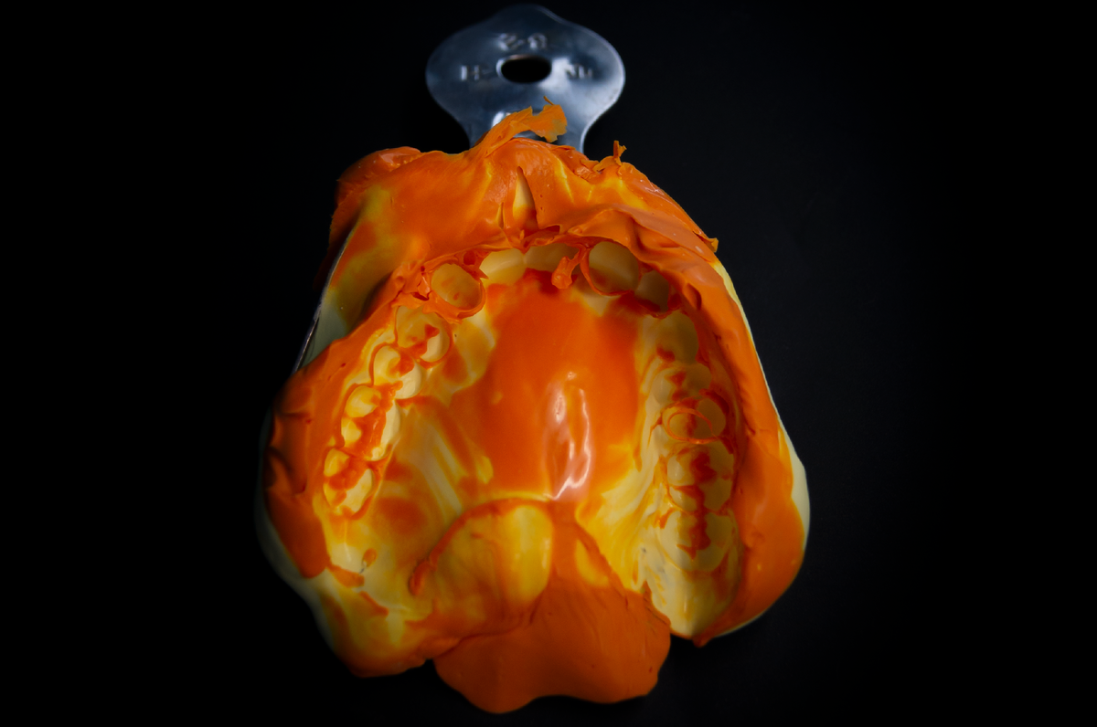 Слепок полного съемного протеза который носил пациент до имплантации.