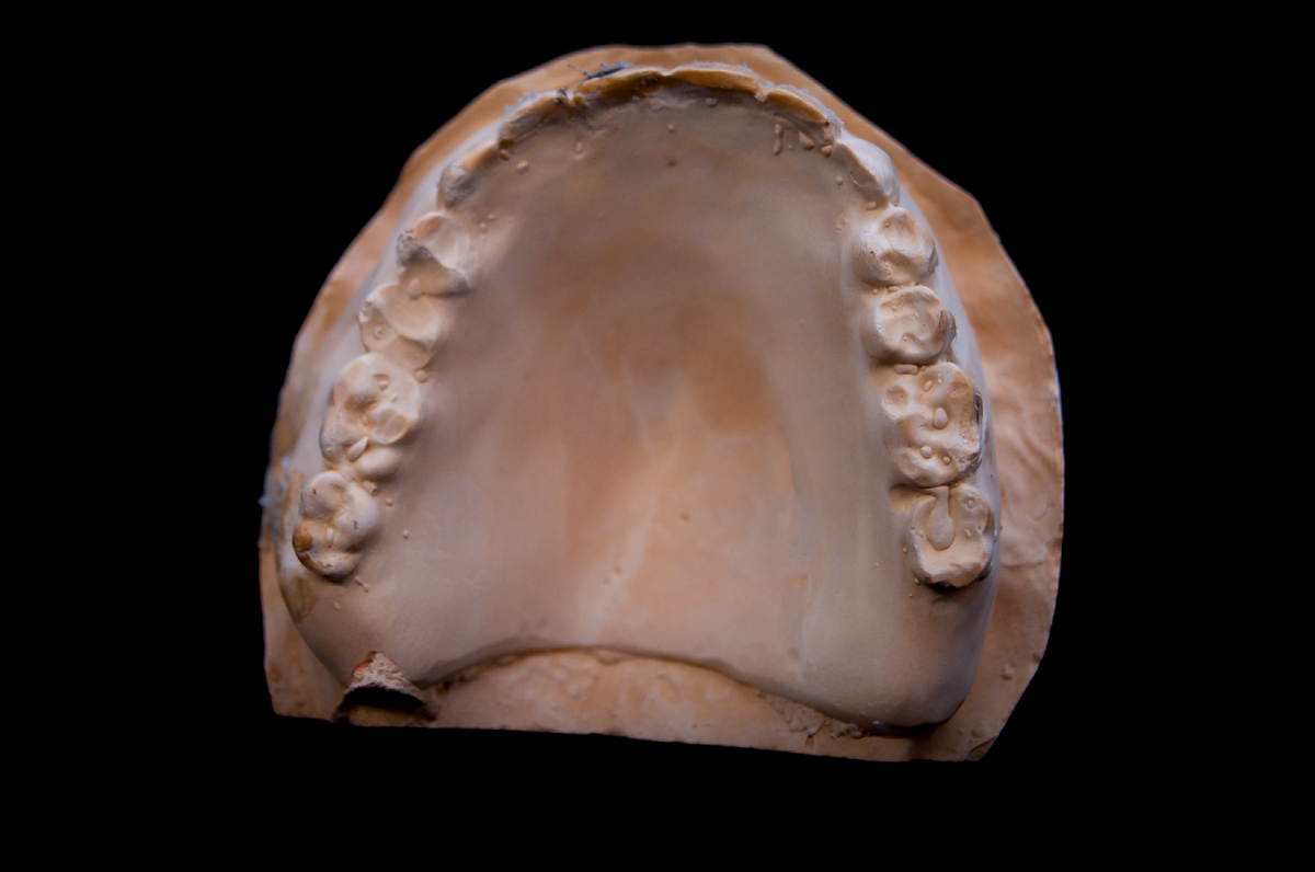 Изготовленная по слепку гипсовая модель. Старый съемный протез.