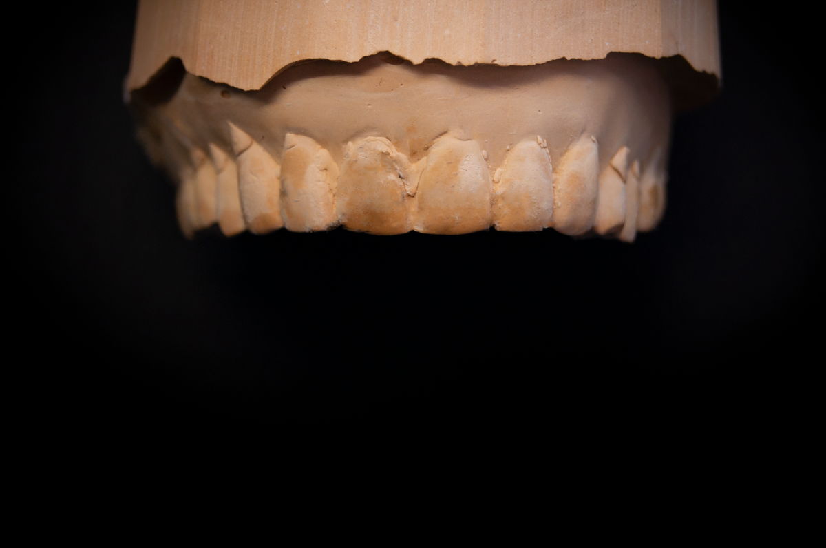 Изготовленная по слепку гипсовая модель. Старый съемный протез.