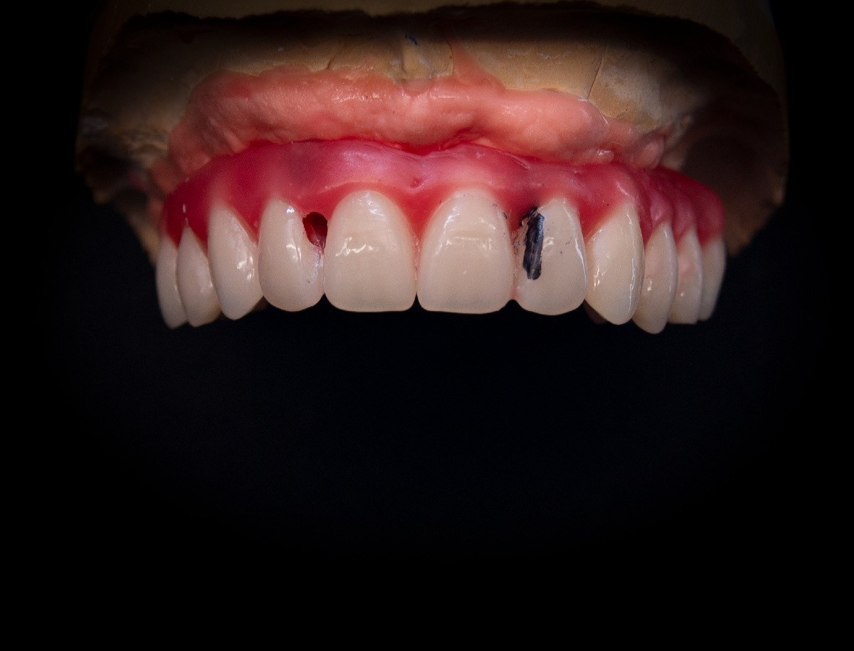 Постановка зубов, восковой базис с гарнитурными зубами.