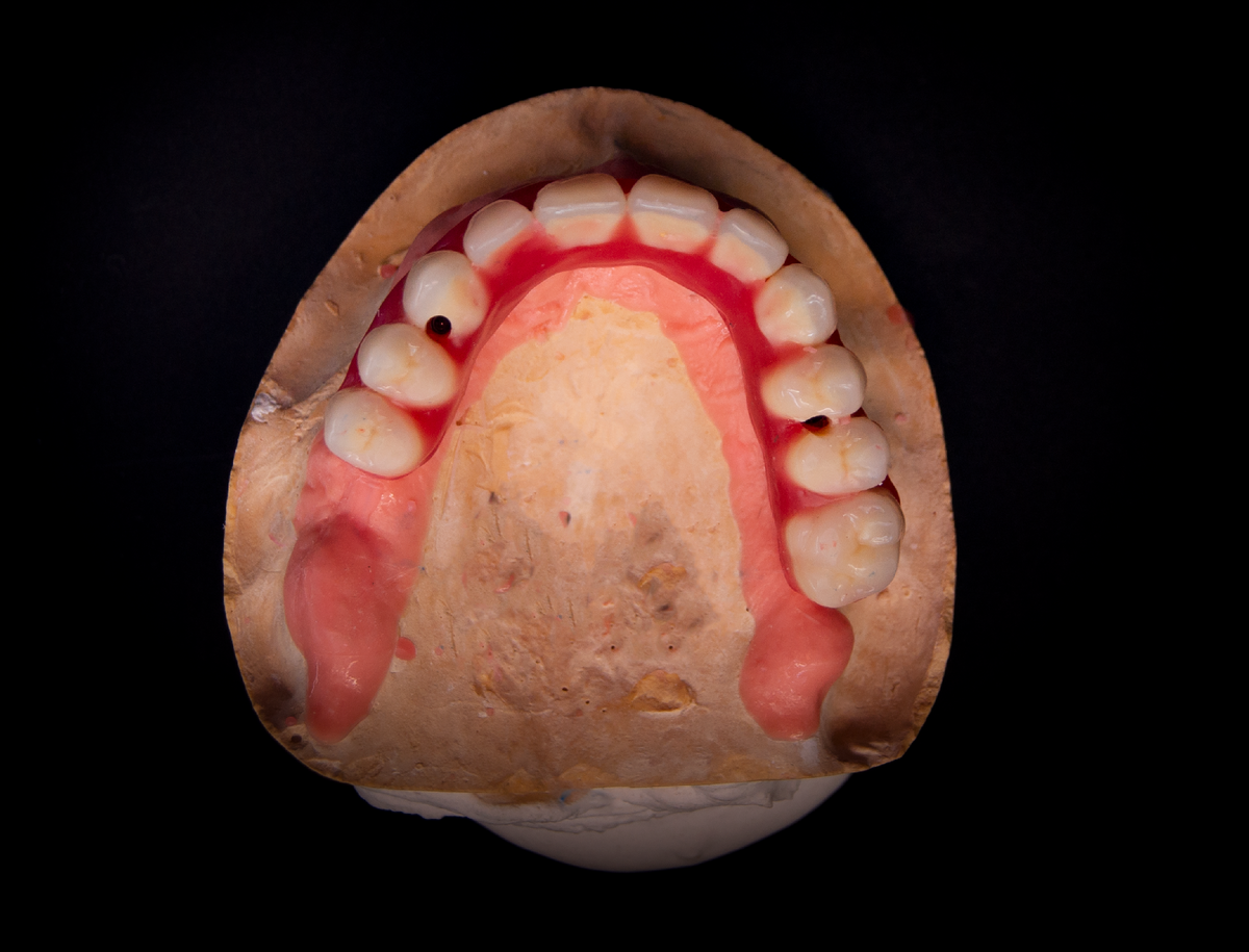 Постановка зубов, восковой базис с гарнитурными зубами.