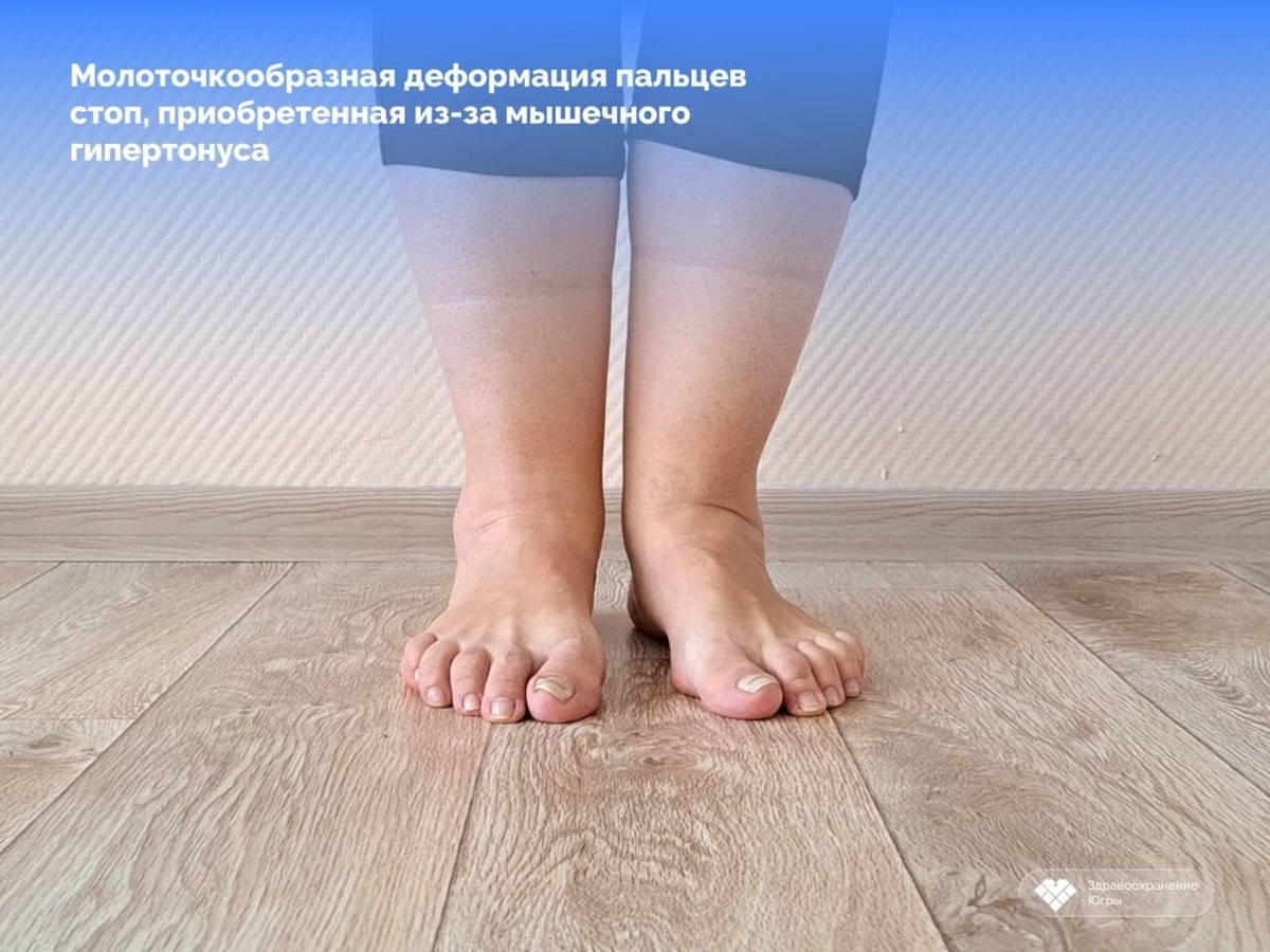    «Примерно как увидеть НЛО». Невролог из Сургута прокомментировал уникальный диагноз, посталвенный горожанке