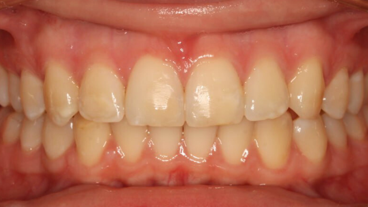 После завершения лечения на элайнерах.