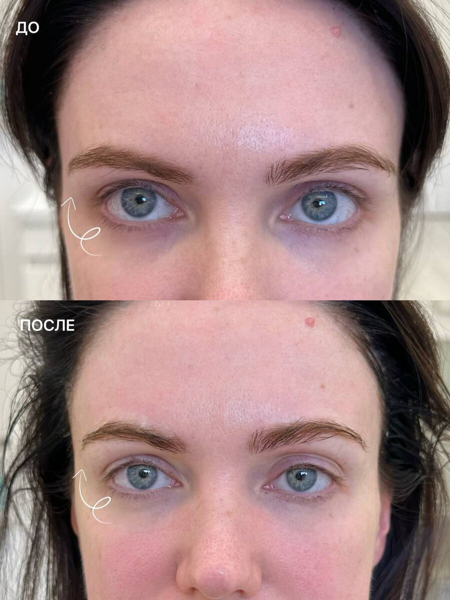 Векторный лифтинг (лба, бровей и верзних век) на Fotona - до/ сразу после процедуры
