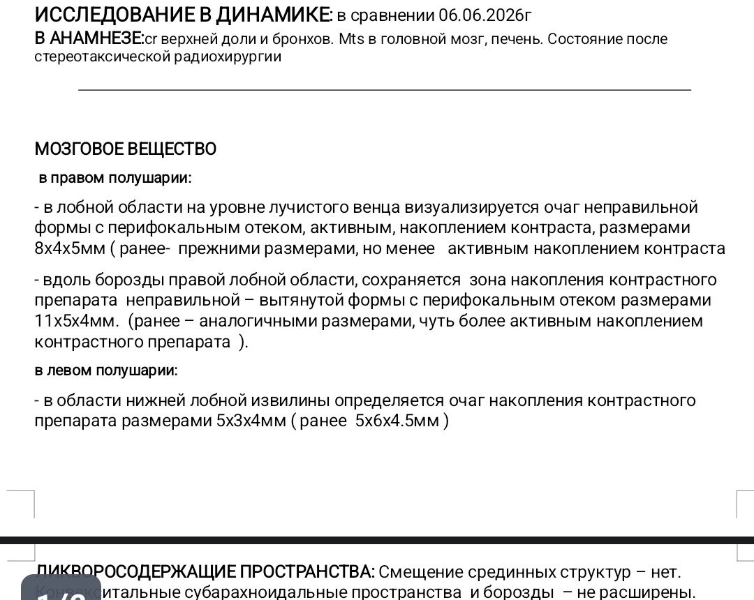 скрин результата МРТ - новый мтс чуть уменьшился. В правом полушарии два облученных