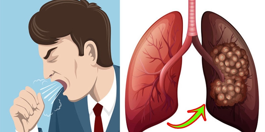 Хронический кашель без температуры — рак лёгких?