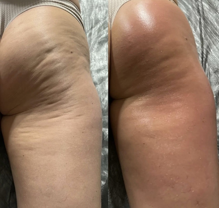 Фото до массажа и после. Взято из интернета