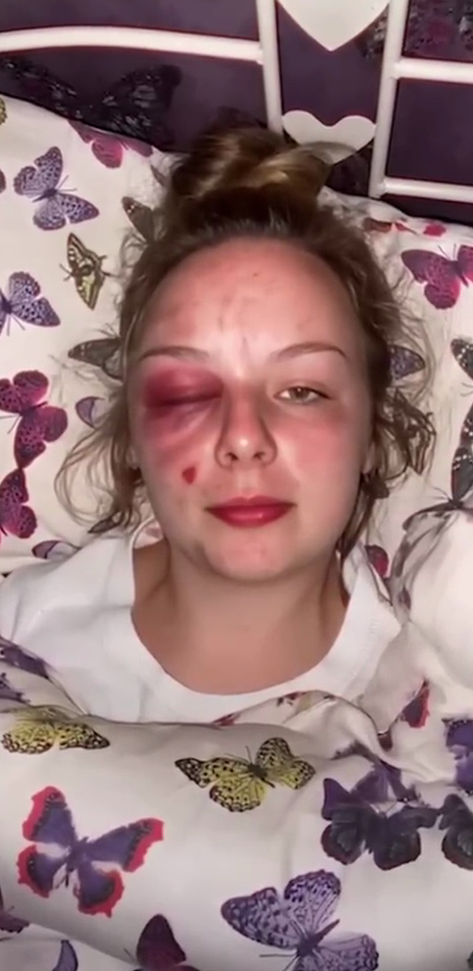 Фотогарфия побоев на теле Элеоноры