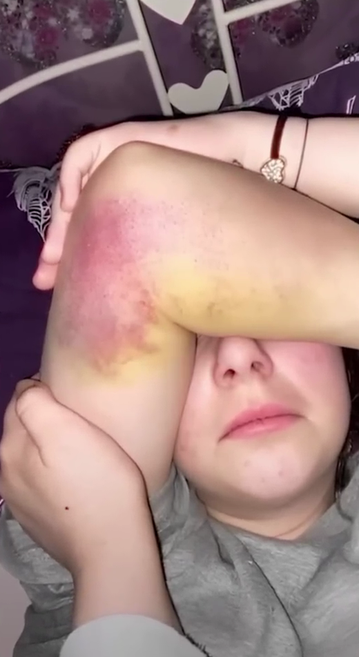 Фотогарфия побоев на теле Элеоноры