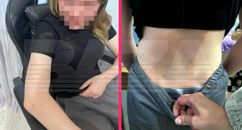 Поджигали и выдирали волосы: подростки жестко избили девочку в Орске