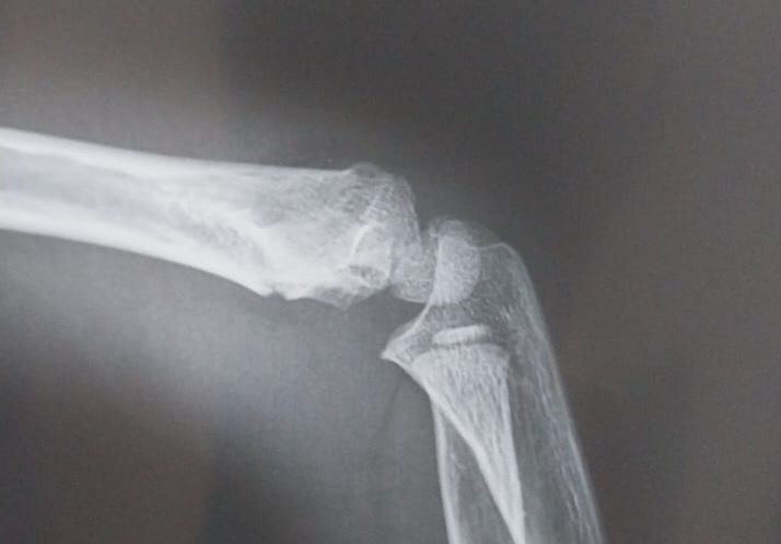 На этом снимке вообще почти не видно, что есть перелом, но трещина была заметна на снеимке в другой плоскости