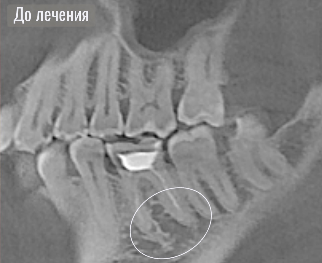 Периодонтит на снимке 