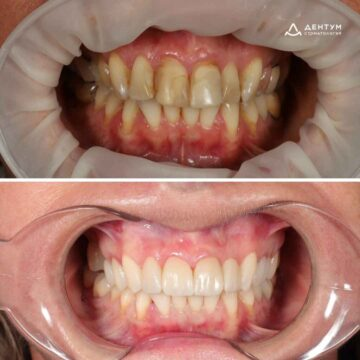 До / После отбеливания Zoom 4