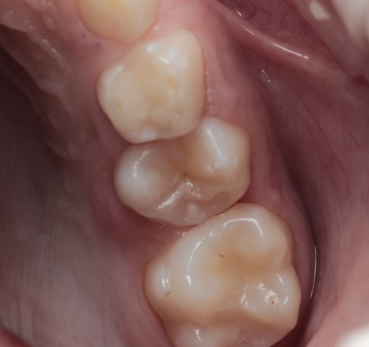 Нераскрытая фиссура 2.4 зуба