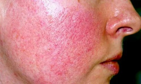 Ретиноловый дерматит