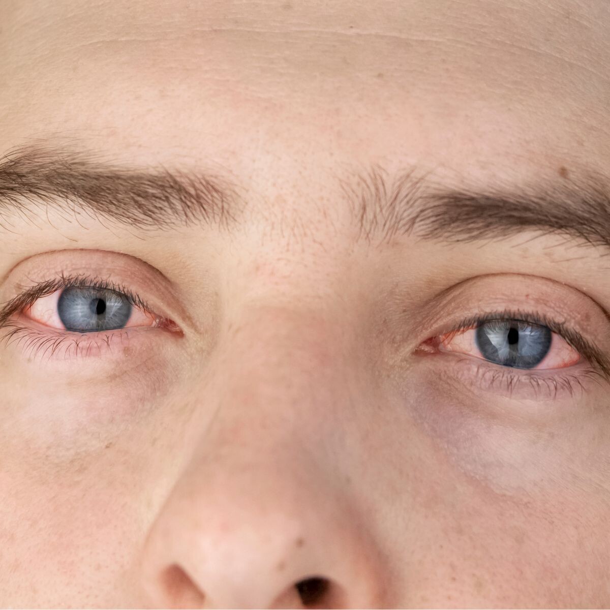 покраснение глаз