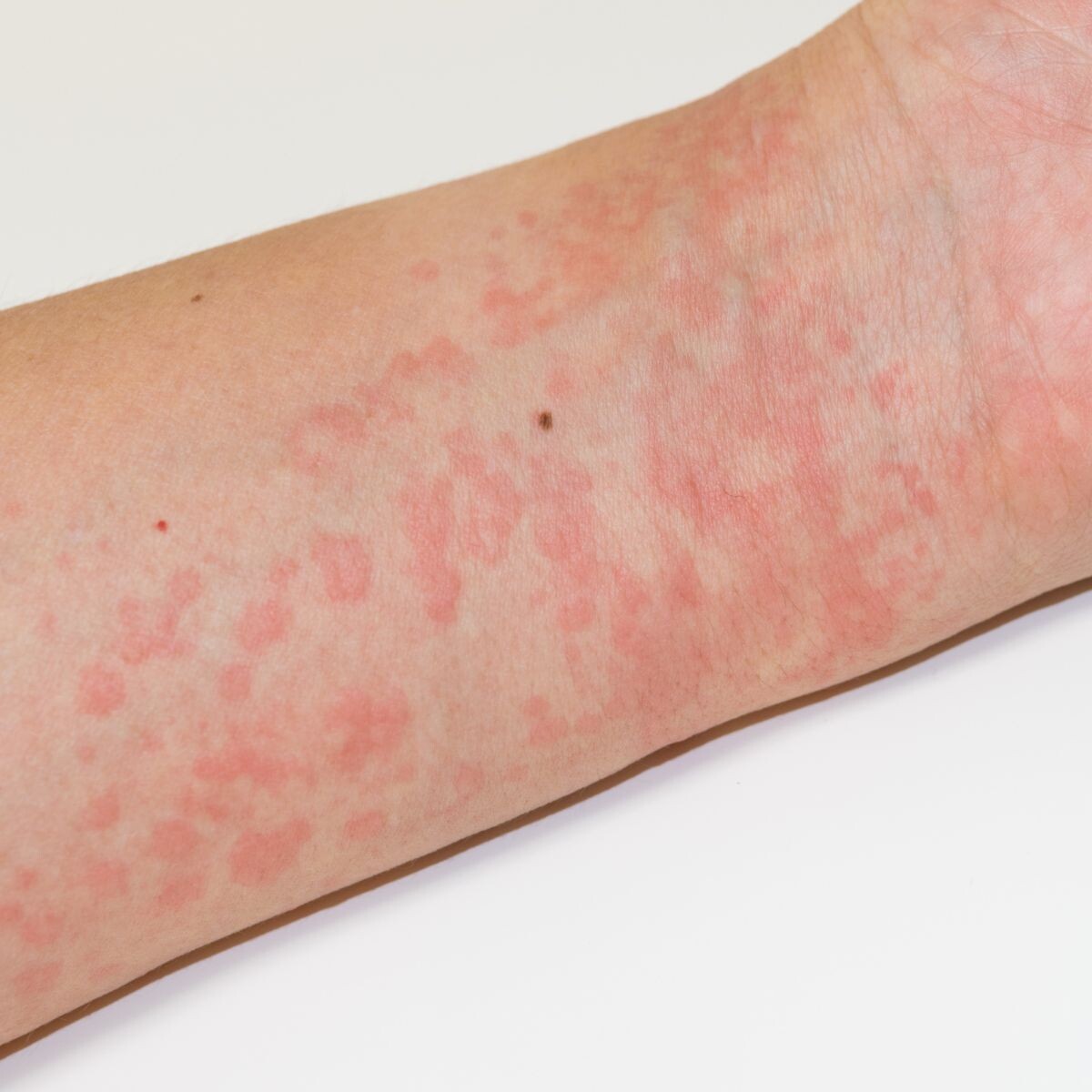 крапивница