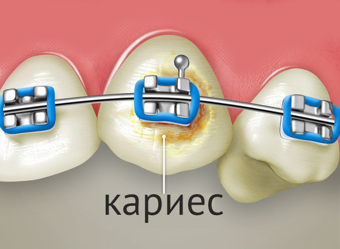 Кариес под брекетом