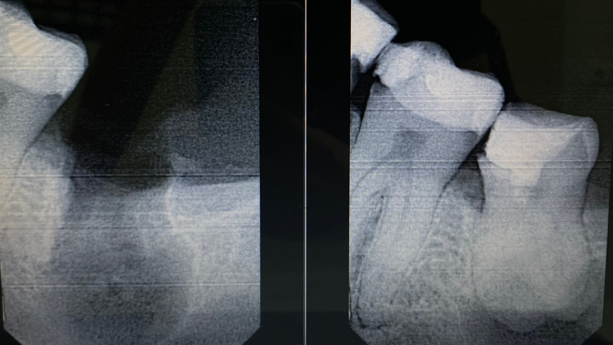 Удаленный зуб «мудрости»