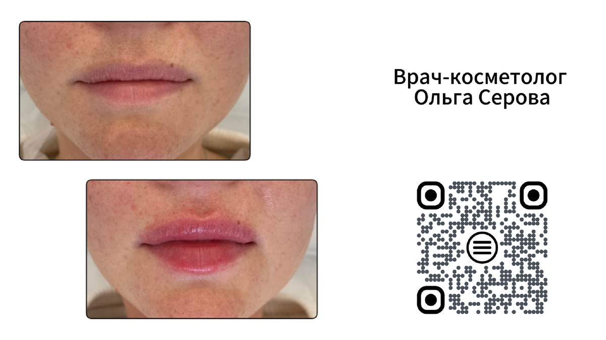 До и сразу после процедуры 