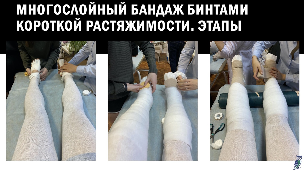 1 - Бинтование пальцев и использование прокладочного "чулка". 2 - Применение прокладочной ваты и (при необходимости) лимфологических прокладок.                            
 3 - Наложение бинтов короткой растяжимости. 