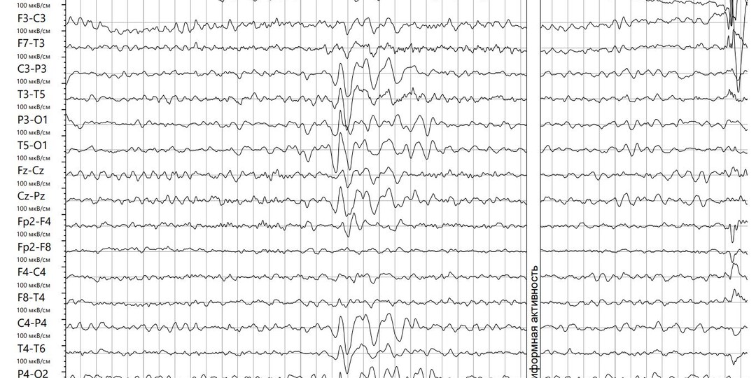 Эпиактивность у недоношенных детей. Не просто «светлячки»: что ждет такого ребенка в будущем?
