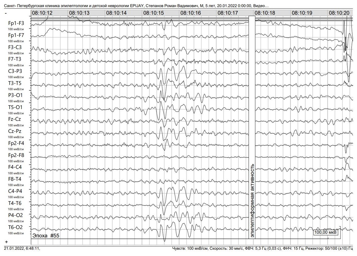 Так выглядит наша эпиактивность на ЭЭГ 