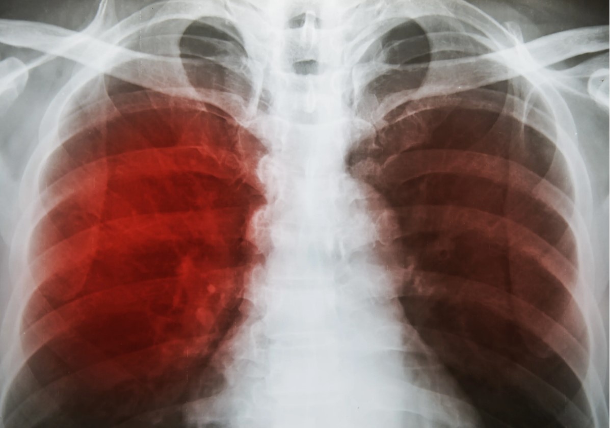 Почему кашель с кровью — не всегда туберкулёз, а хуже