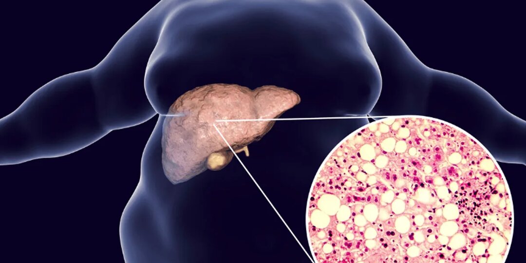 Жировой гепатоз печени: «тихая бомба» в животе, которую можно обезвредить — если вовремя заметить