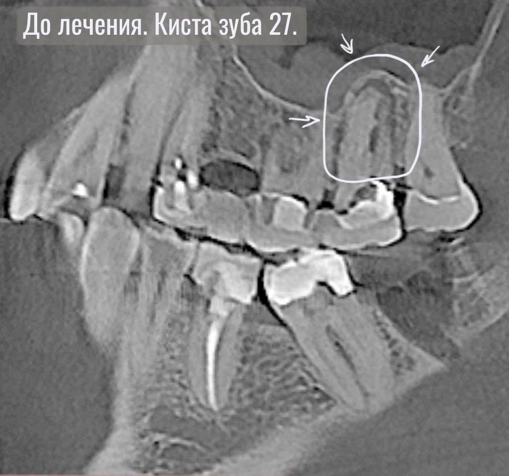 Воспаление в зубе 27
