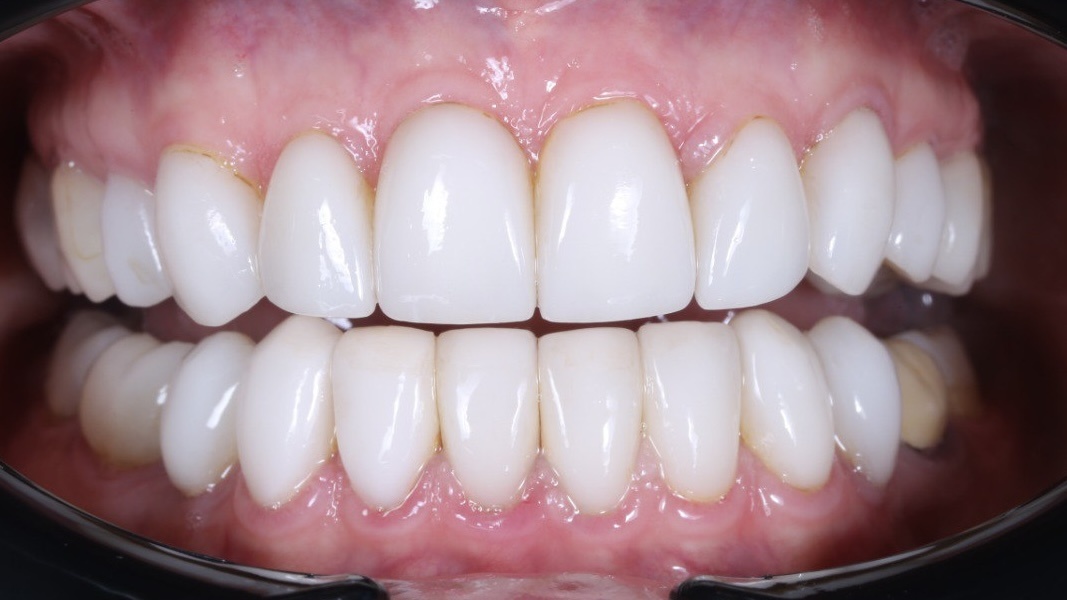 Старые виниры до процедуры