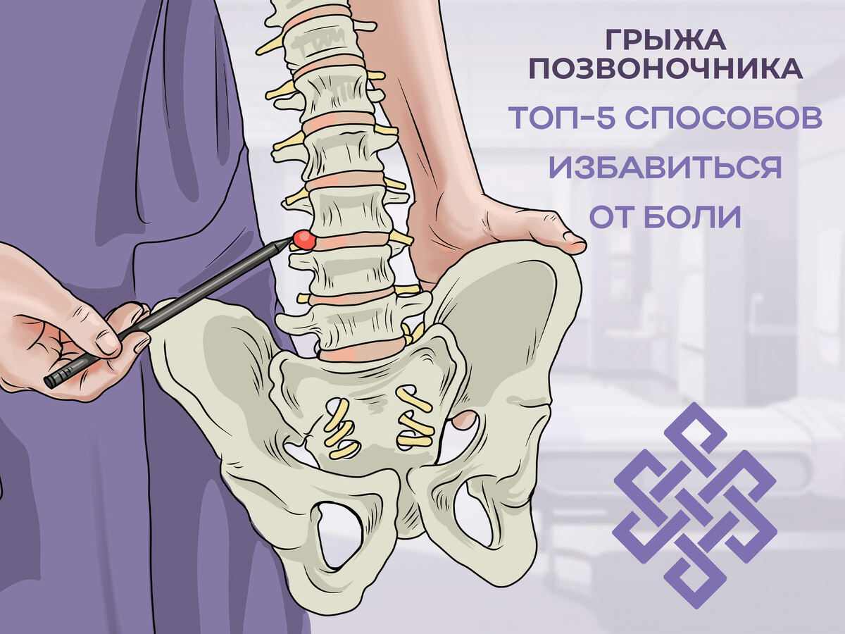 Грыжа позвоночника 