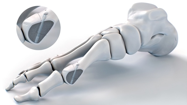 Демонстрация имплантов MgSorb на RusFAS: шаг к новым возможностям медицины