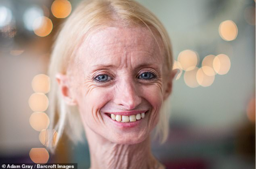 В мире таких людей — единицы. И каждый их день — это борьба не только за жизнь, но и за ощущение нормальности. Источник: sarayanews.com