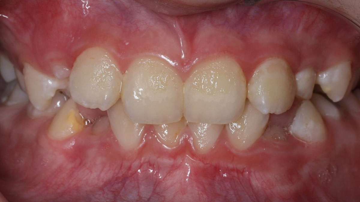 Скученность зубов у ребёнка. 