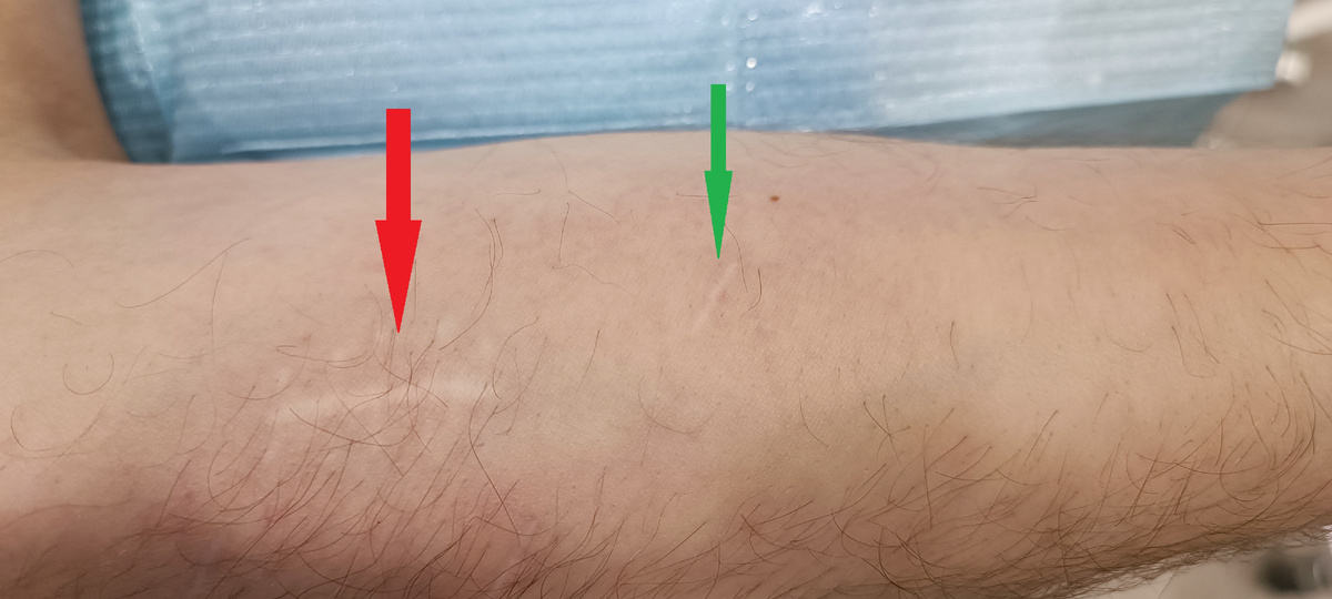Рубцы после удаления липом. В нашей клинике - зеленая стрелка, в другой клинике - красная стрелка.